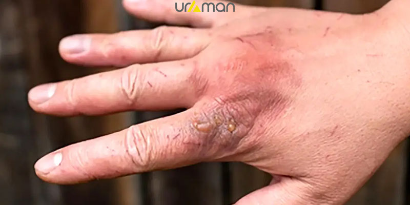 عوارض مارگزیدگی